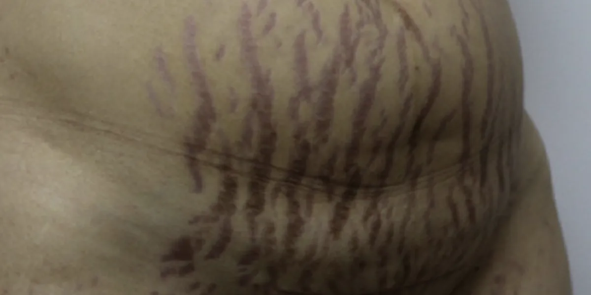 Resultado antes del tratamiento en Kinetria
