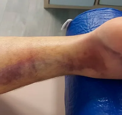 Recuperación de paciente atendido en Kinetria